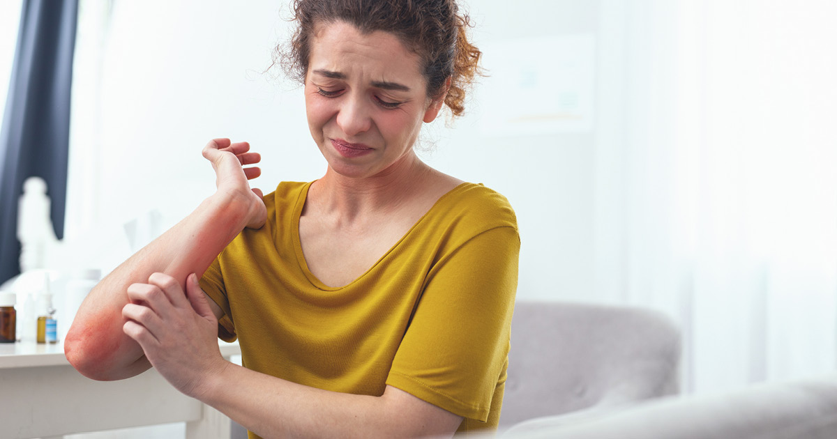 Estudo mostra eficácia do ivarmacitinib no tratamento de dermatite atópica