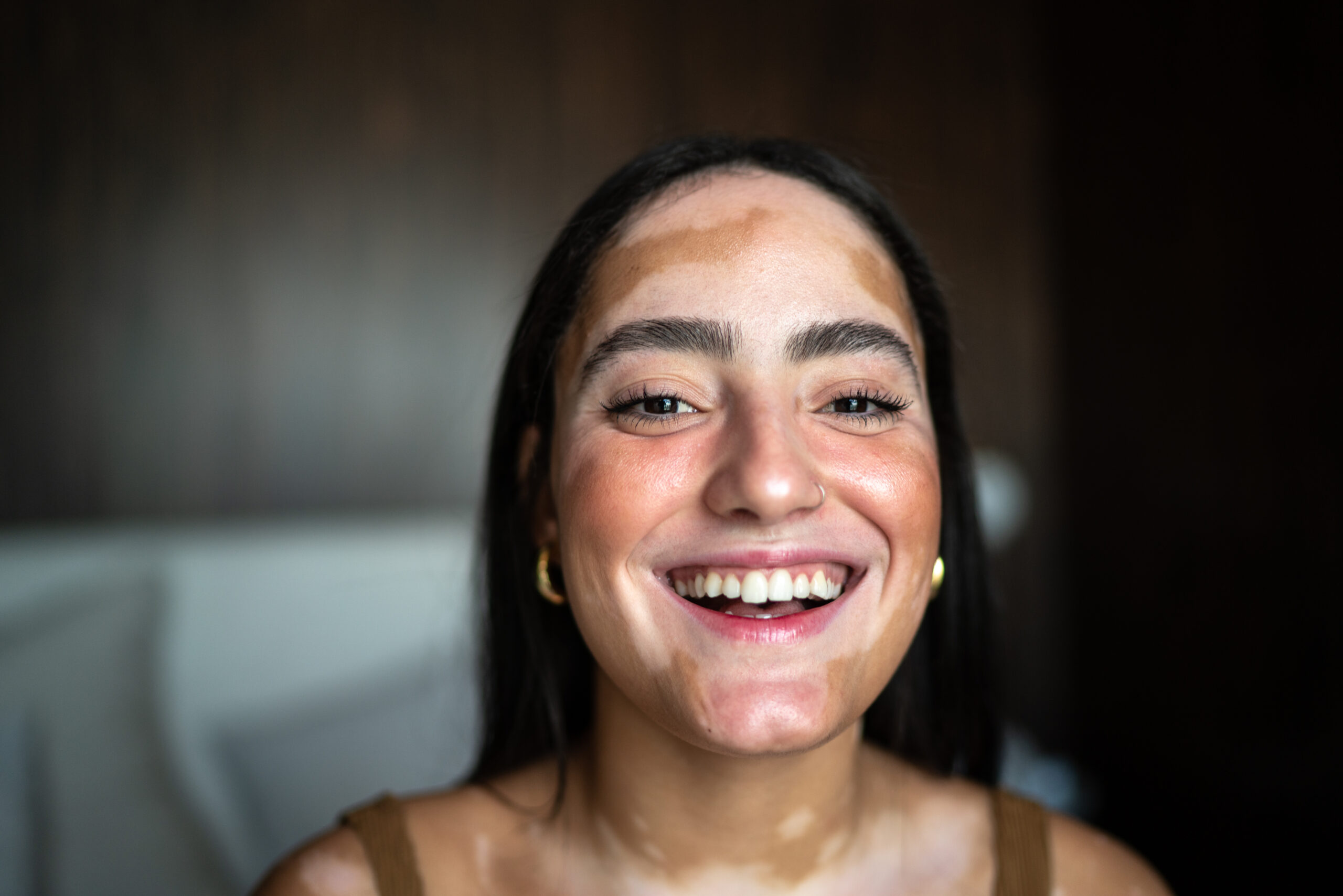 Dia Mundial do Vitiligo: Informação e tratamento resgatam autoestima dos pacientes