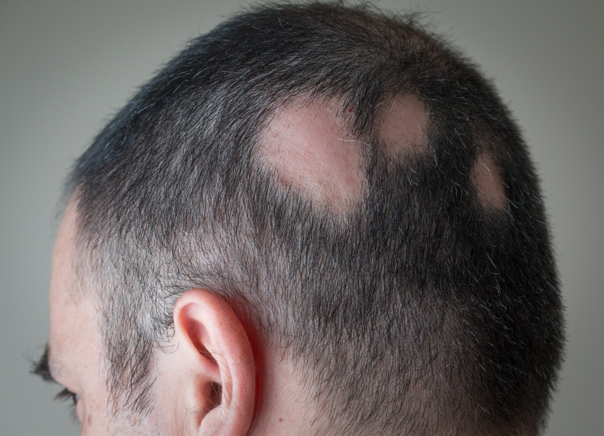 Alopecia Areata: Queda de Cabelo Pode Indicar Doença Autoimune