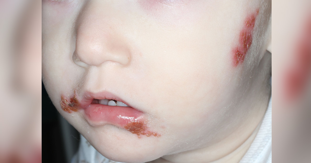 Infecção cutânea pelo vírus herpes simplex em criança saudável de 5 anos