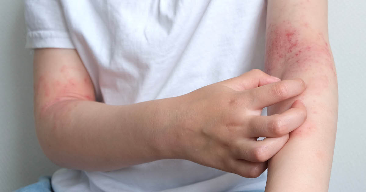 Estudo mostra que creme tapinarof 1% melhora significativamente o sono em pacientes com dermatite atópica