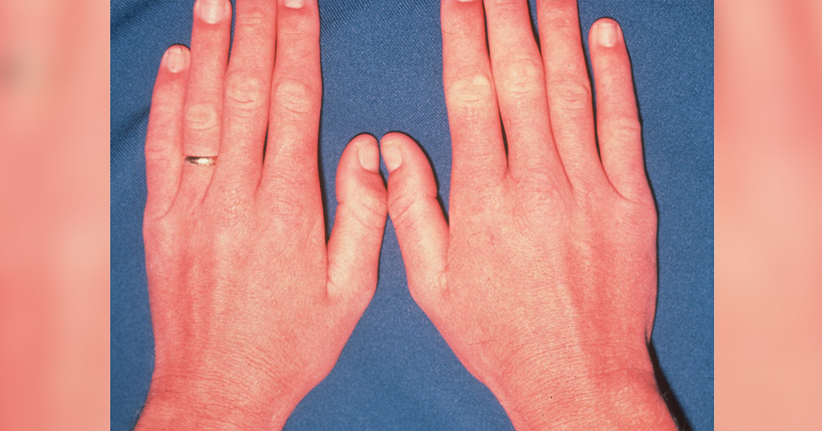 Soldado desenvolve febre e dor de cabeça após viagem a Porto Rico