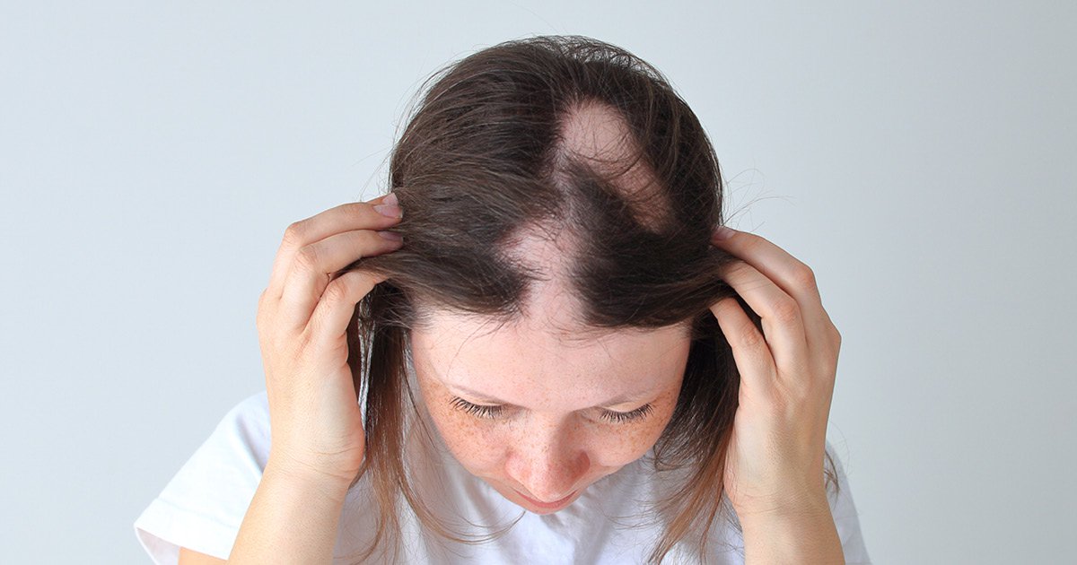 Novo tratamento melhora a queda de cabelo em pacientes com alopecia areata grave