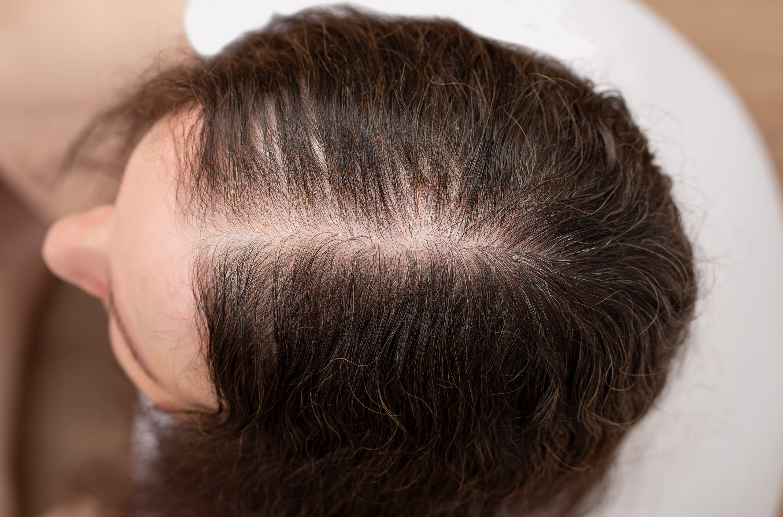 Alopecia Androgenética e Alopecia Areata: Principais Causas de Queda de Cabelo em Mulheres