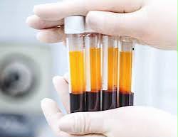 CFM autoriza uso de PRP em osteomusculares com critérios rigorosos e regulamentação atualizada