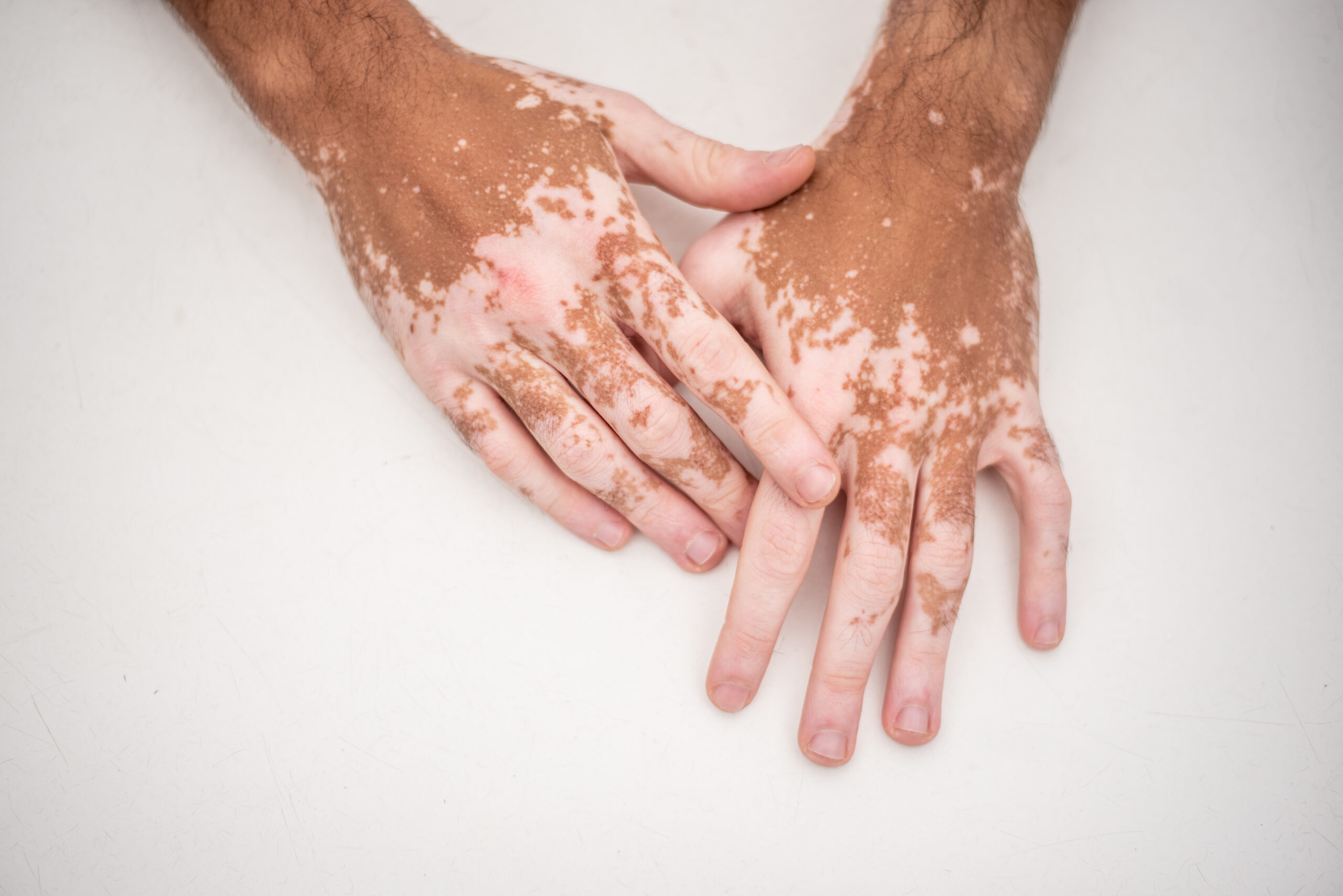 Vitiligo: SBD reforça importância de informação correta e acolhimento no Dia Mundial da Doença
